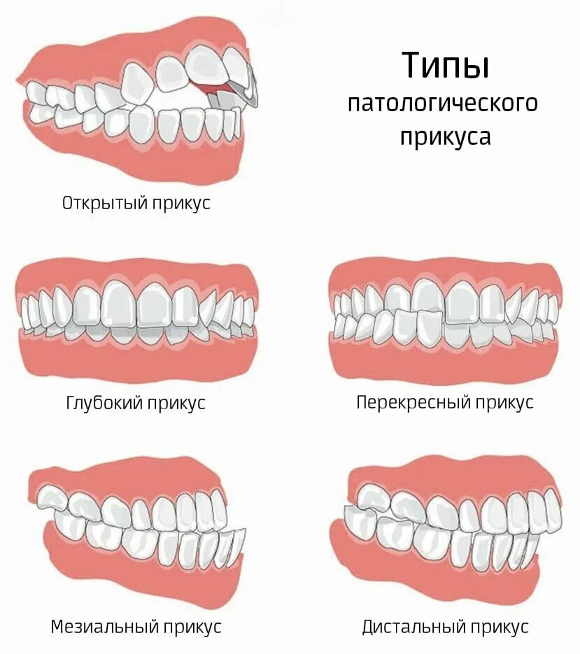 Можно ли есть зубы. Схемы зубов прикус. Прикус зубов правильный схема. Правильный прикус зубы верхней челюсти.