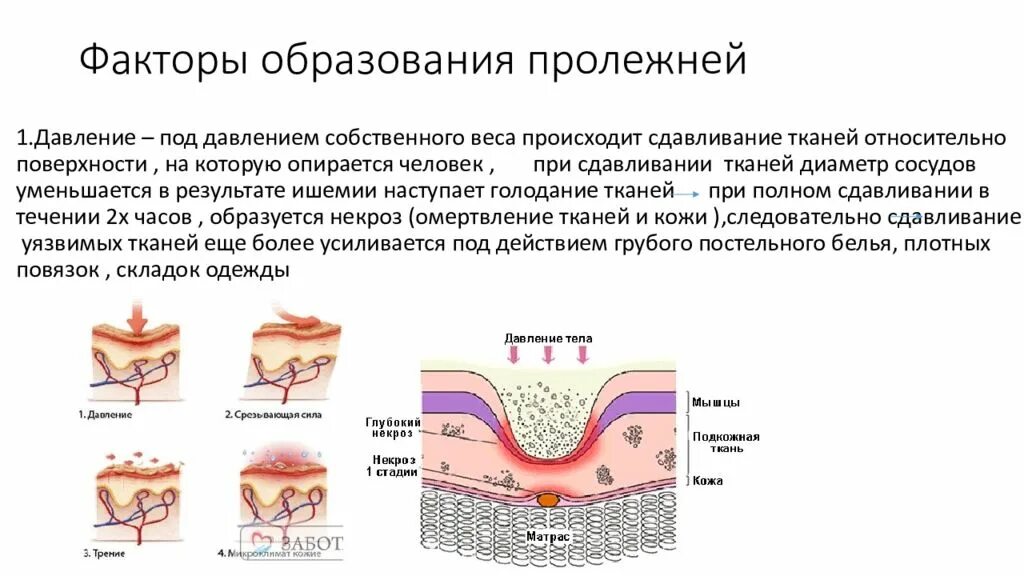 III стадия пролежней характеризуется. Четвертая стадия развития пролежней. Стадии пролежни в сестринском деле. Характеристика стадии развития пролежней.