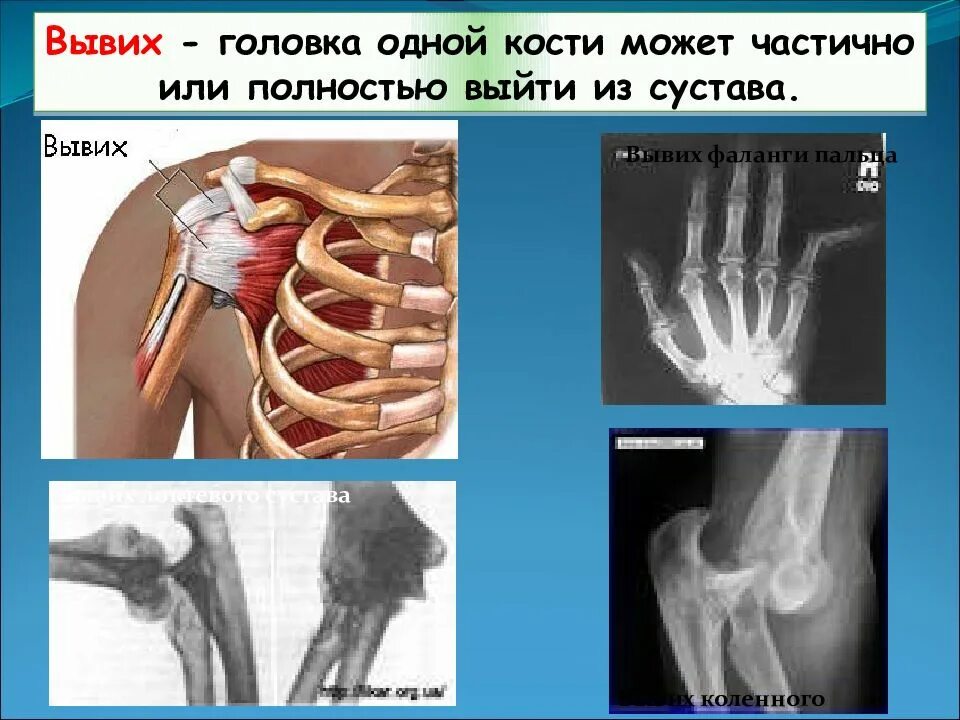 Переломы вывихи растяжения связок ушибы