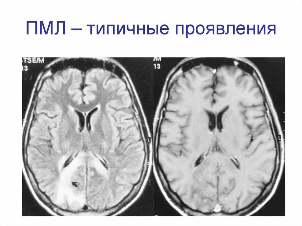 Многоочаговое поражение мозга. Прогрессирующая лейкоэнцефалопатия мрт. Мультифокальная лейкоэнцефалопатия. Прогрессирующая мультифокальная лейкоэнцефалопатия кт. Лейкоэнцефалопатия головного мозга мрт.