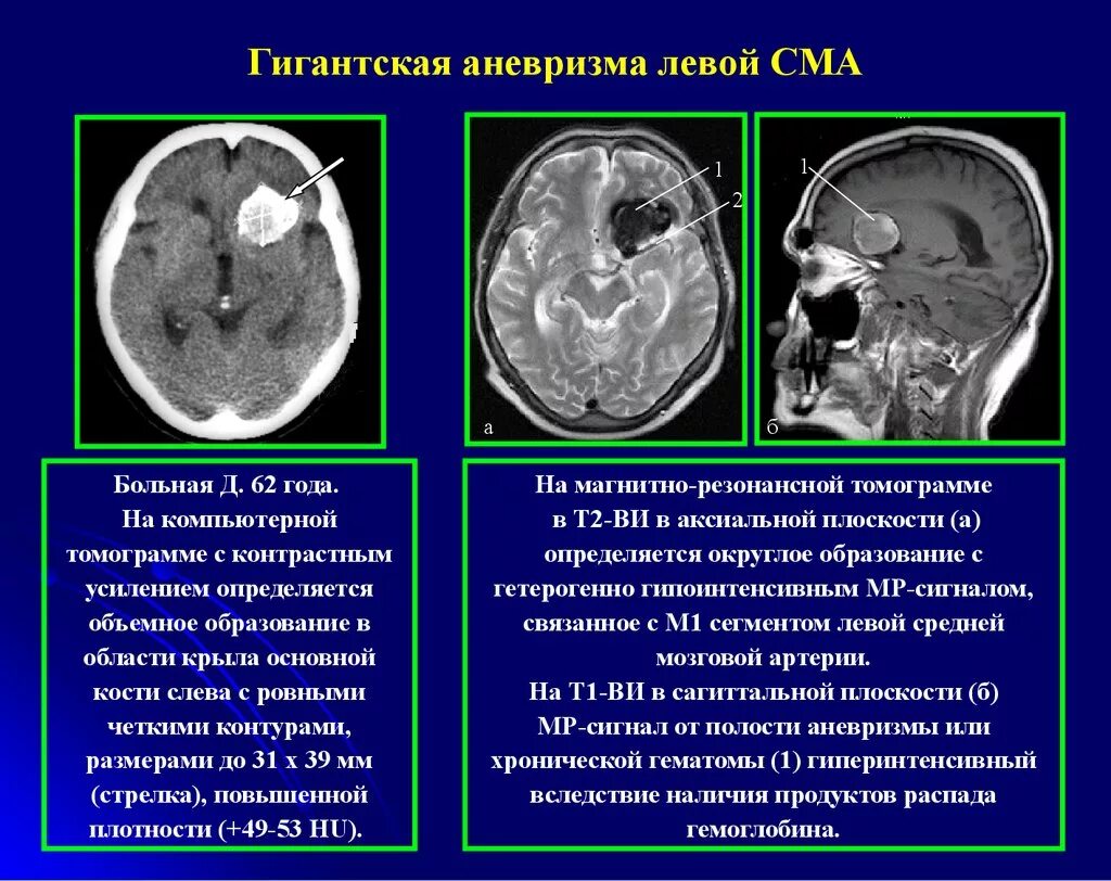 Аневризма головного мозга на кт. Аневризма средней мозговой артерии мрт. аневризма мозговых артерий кт. кт-диагностика аневризм средней мозговой артерии. сосудистые мальформации кт мрт.