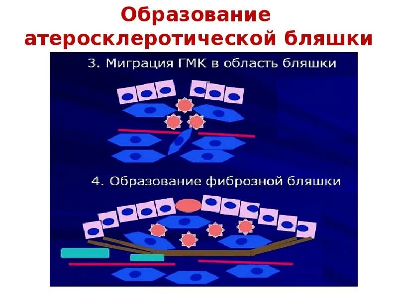Образование атеросклеротической бляшки. Механизм образования атеросклеротической бляшки. строение атеросклеротической бляшки. схема образования атеросклеротической бляшки.