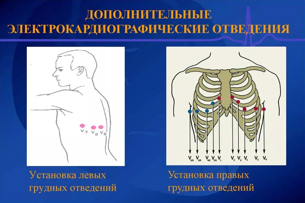 Расположение 6 грудных электродов. Наложение электродов грудные отведения ЭКГ. Электрокардиография грудные отведения. Грудные отведения v7 - v9 задние. Правые грудные отведения