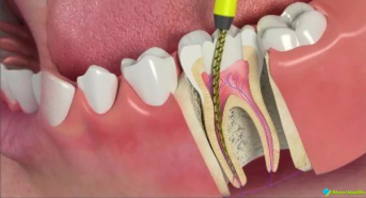Расширение каналов зубов. Пульпит 2 канального зуба.