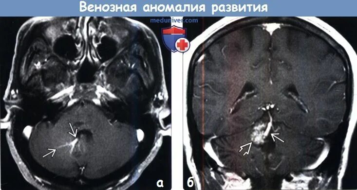 Кавернома головного мозга кт. Кавернозная ангиома мрт. Венозная аномалия головного мозга мрт. Венозная мальформация головного мозга мрт. Ангиома правой лобной