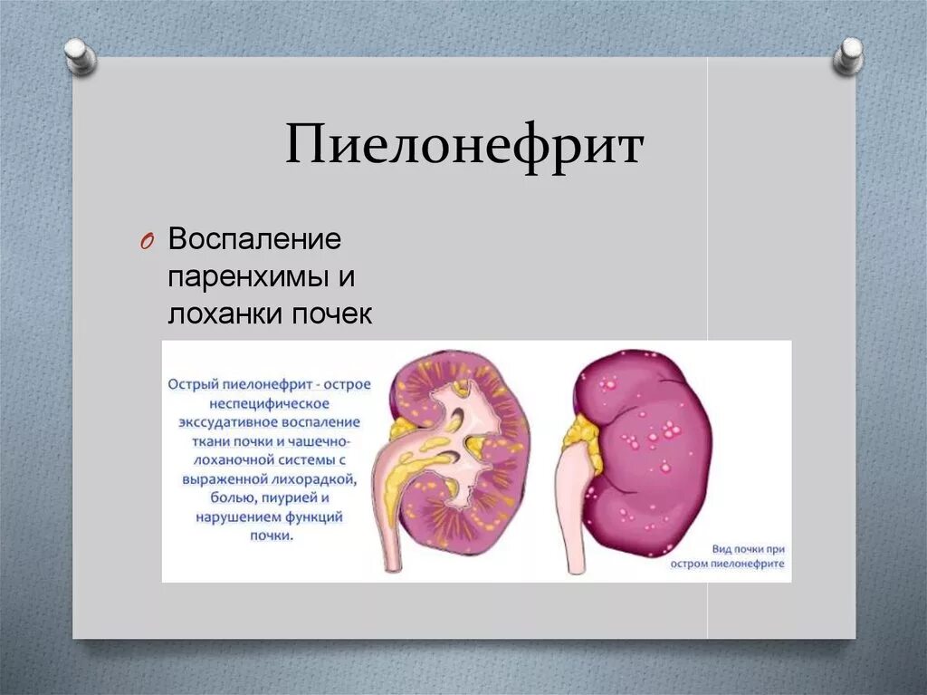 Пиелит это. Воспаление почек пиелонефрит. Пиелонефрит почек воспаление почек. Воспаление почек и почечных лоханок на латинском. Почка деформация пиелонефрит.