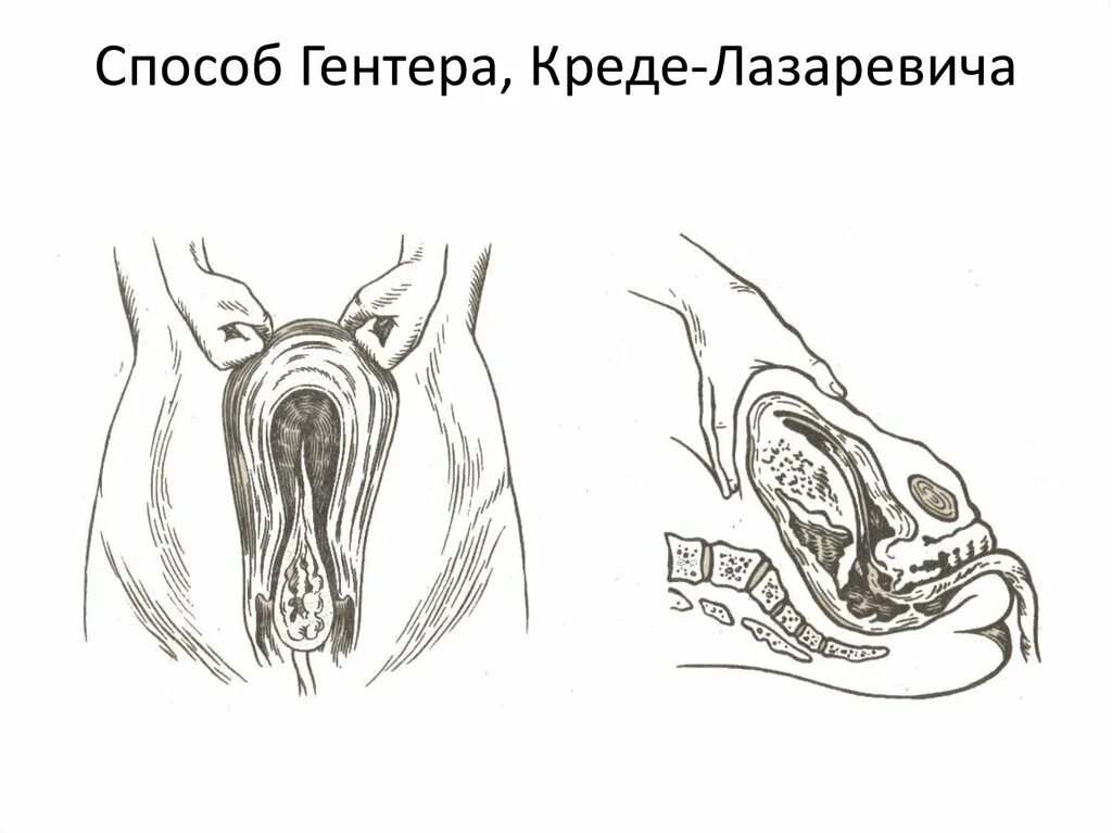 Массаж матки после родов. Способы выделения последа (Абуладзе, Креде-Лазаревича, Гентера). Способ Абуладзе способ Креде-Лазаревича способ Гентера. Абуладзе Креде Лазаревича. Метод Креде-Лазаревича Абуладзе.