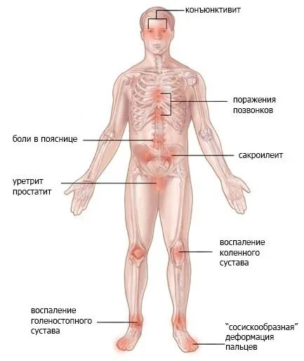 Синдром кехрера. Синдром рейтера этиология. синдром рейтера суставной синдром. синдром рейтера уретрит. клинические проявления синдрома рейтера.