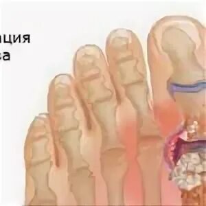 Почему щелкают суставы