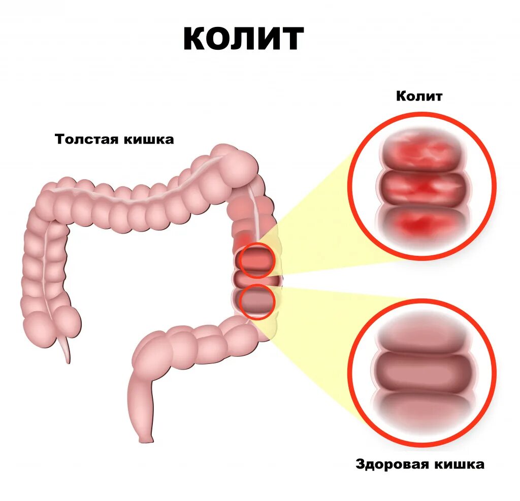 Колит - причины появления, симптомы заболевания, диагностика и способы лечения