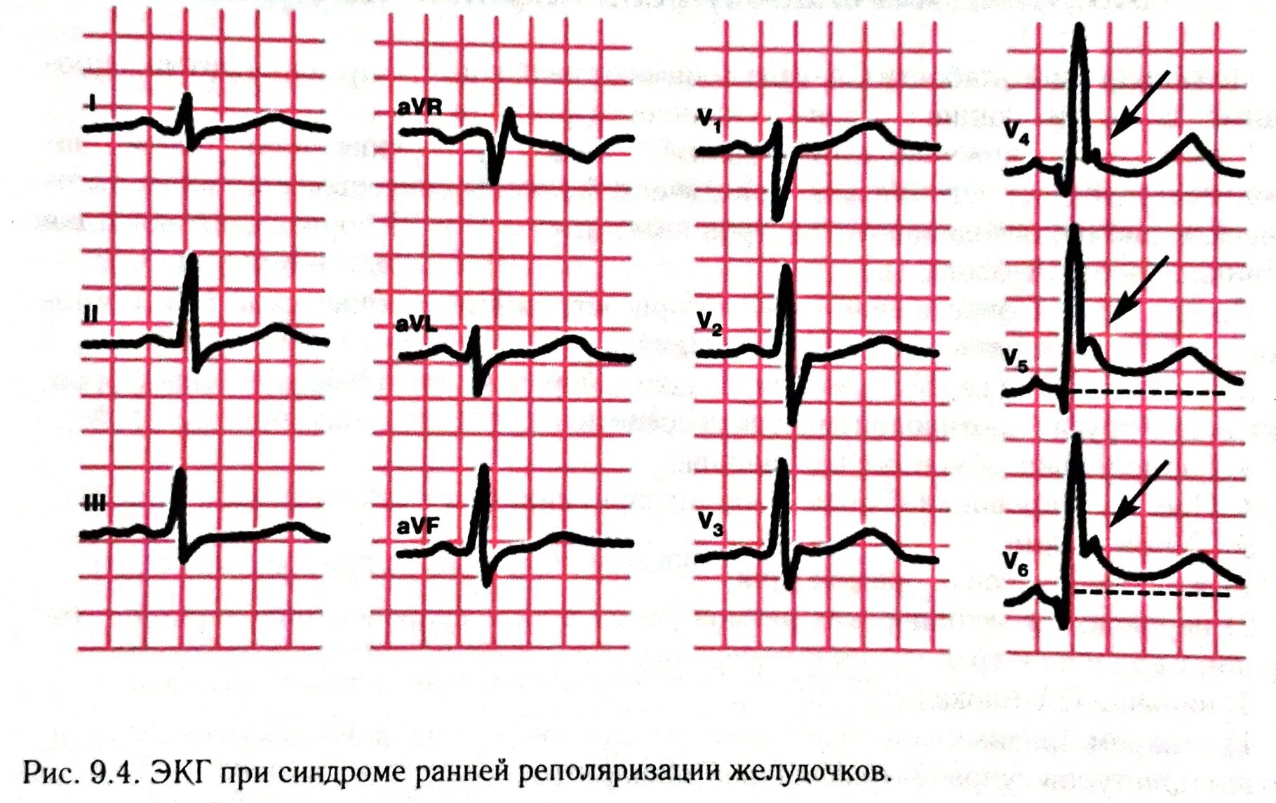 Реполяризация миокарда желудочков ЭКГ. Реполяризация миокарда на ЭКГ. Ранняя реполяризация желудочков на ЭКГ. Синдром ранней реполяризации желудочков на ЭКГ. Изменение реполяризации левого желудочка