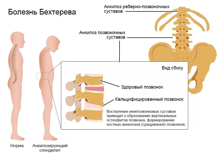 Анкилозирующий спондилоартрит болезнь Бехтерева. Болезнь Бехтерева поясничный отдел позвоночника. Анкилозирующий спондилит болезнь Бехтерева. Болезнь Бехтерева или анкилозирующий спондилоартрит;.