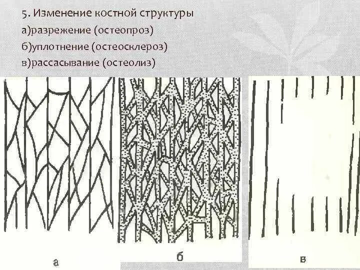 Изменения костной структуры. Разрежение костной структуры. изменение структуры костей (разрежение и сглаживание поверхности).. изменение костной структуры. что значит разрежение костной структуры.