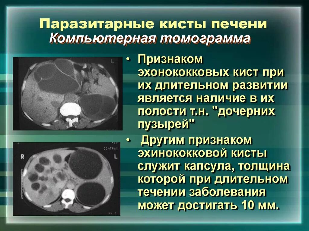 Киста на печени чем опасна у женщины. Эхинококковая киста печени кт. Кисты печени кт эхинококкоз. Эхинококковая киста в печени коровы. Эхинококковая киста брюшной полости кт.