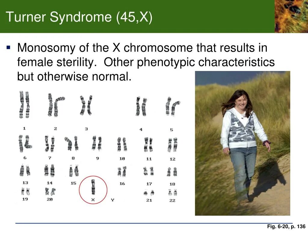 Отсутствие х хромосомы у мужчин. Синдром Шерешевского Тернера кариотип. Синдром Шерешевского Тернера хромосомы. Кариотип при синдроме Тернера. Шерешевский Тернер кариотип.