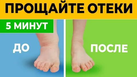 Отеки на 30 неделе