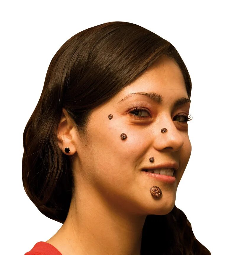 родинки бородавки папилломы. бородавки родинки на лице. бородавки родинки на лице. бородавки родинки на лице. папилломы на лице до после.