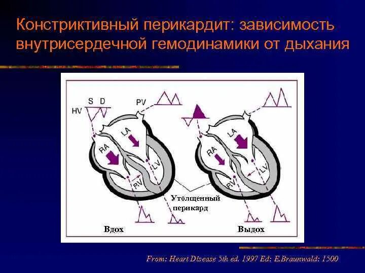 Внутрисердечная гемодинамика. ЭХОКГ при констриктивном перикардите. Конструктивный перикаодит. Слипчивый констриктивный перикардит. Констриктивный перикардит Эхо кг.