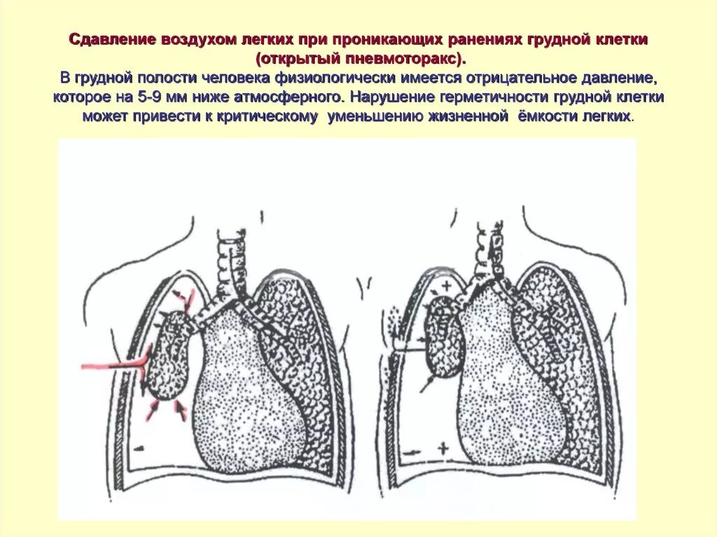 Признаки воздуха в легких. Форма грудной клетки при пневмотораксе. Ранение в грудную клетку пневмоторакс. Сдавлениегрудной клетк. Рана грудной клетки проникающая в плевральную полость.