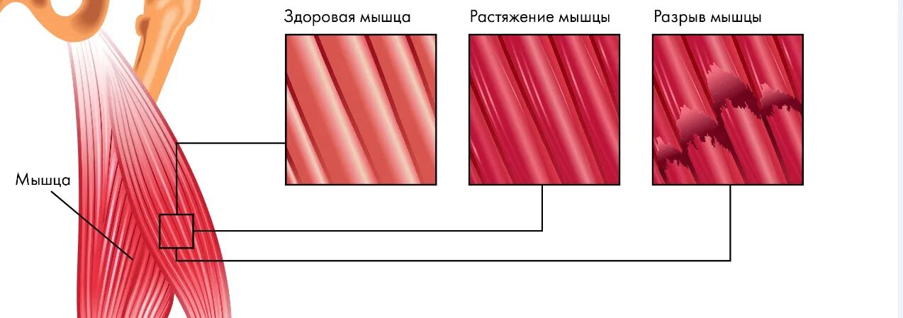 Признаки разорванной мышцы. Микроразрывы общего разрыва мышц. Симптомы порванной мышцы задней поверхности.