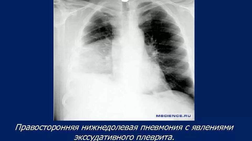 Внебольничная пневмония осложненная экссудативным плевритом. Пневмония осложненная плевритом рентген. Нижнедолевая пневмония с плевритом. Нижнедолевая пневмония рентген. Пневмония в нижней доле правого легкого