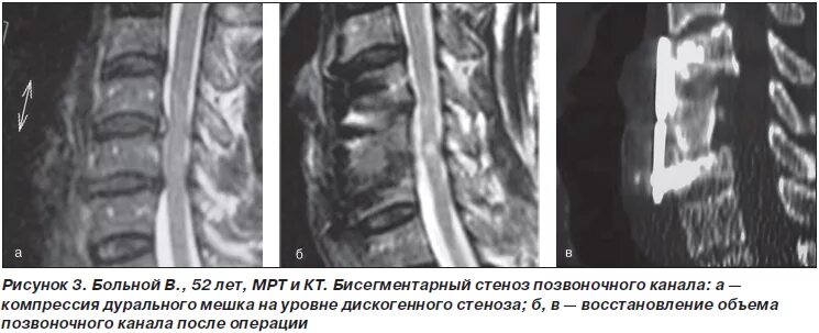 стеноз l3 l4. декомпрессия корешков позвоночника. относительный сагиттальный стеноз позвоночного канала с5-с7. абсолютный стеноз l4/s1. межпозвонковый дисковый стеноз неврального канала.