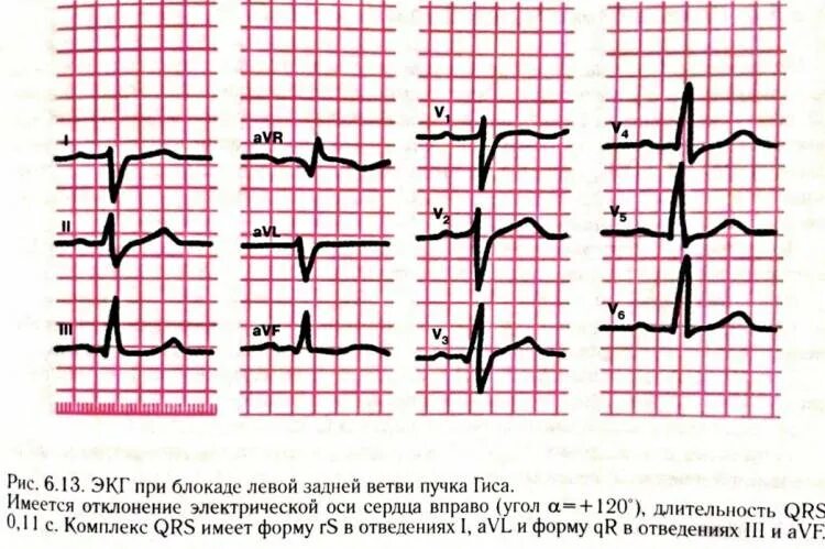 Блокада передне лнпг. Блокада задней ветви левой ножки пучка Гиса. Неполная блокада передней ветви ЛНПГ на ЭКГ. Блокада задней ветви ЛНПГ на ЭКГ. Блокада левой ножки пучка Гиса на ЭКГ.