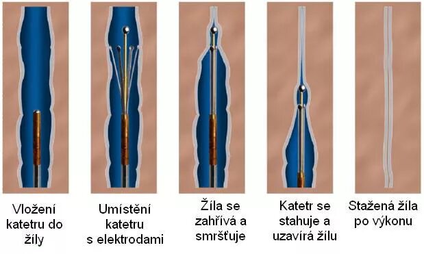 Абляция пищевода. Радиочастотная облитерация (абляция) вен. Лазерная облитерация (коагуляция) вен. Эндовазальная лазерная абляция.