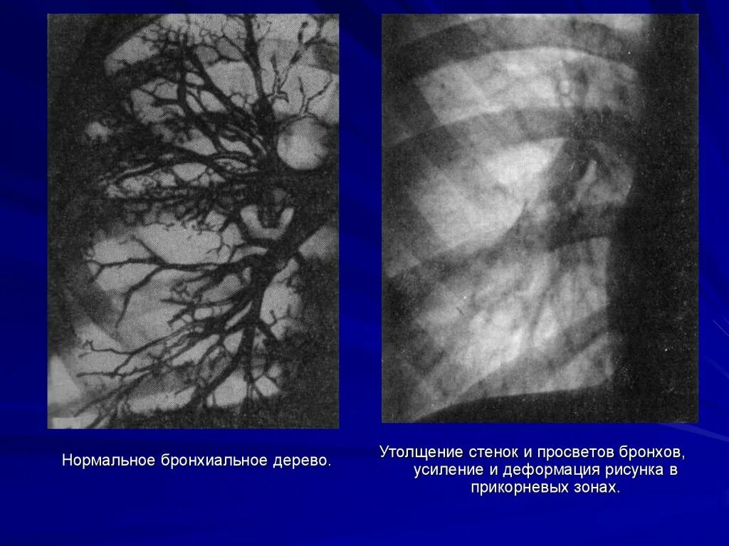 Стенки бронхов утолщены. Размер правой доли печени в норме по узи. Расширение и уплотнение аорты. Умеренно уплотненная. Умеренно уплотненная.