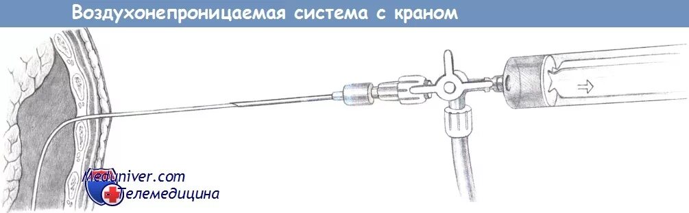 Пункция экссудата. Игла дюфо для плевральной пункции. набор для дренирования плевральной полости (игла 1,8х80мм),. пункция плевральной полости иглой дюфо. система для пункции плевральной полости.