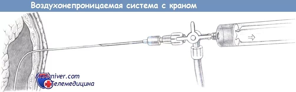 Инструменты для пункции плевральной полости. Игла Дюфо для плевральной пункции. Система для пункции плевральной полости. Инструменты при плевральной пункции. Пункция через задний свод