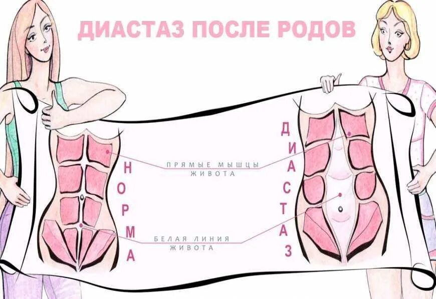 Диастаз после беременности. Диастаз прямых мышц живота. Расхождение прямых мышц живота.