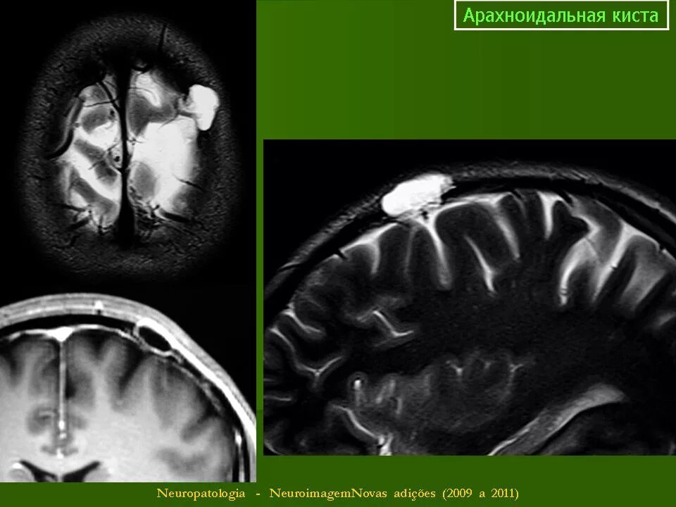 Киста в лобной доле. Ретроцеребеллярная арахноидальная киста мрт. Арахноидальная киста лобной доли. Арахноидальная киста большой затылочной цистерны. Ликворная киста головного мозга кт.
