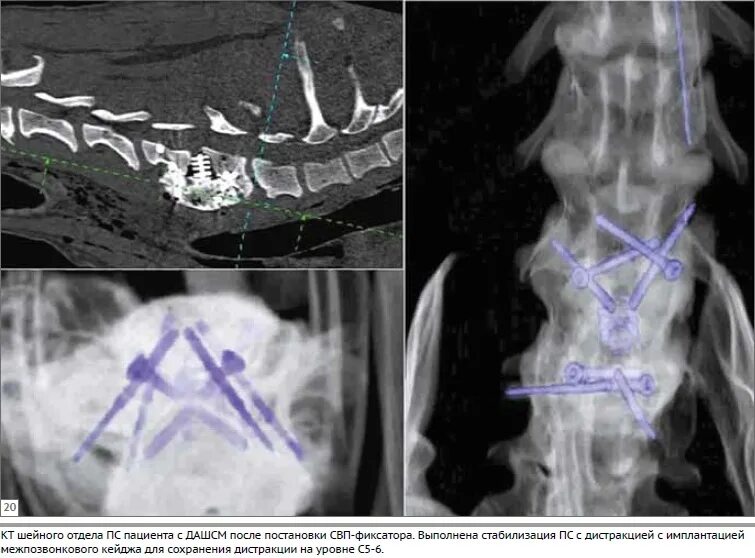 Стеноз у собак. Вертебропластика позвоночника рентген. Вертебропластика s1 позвонка. Транспедикулярная фиксация позвоночника у собак. Люмбосакральный стеноз.