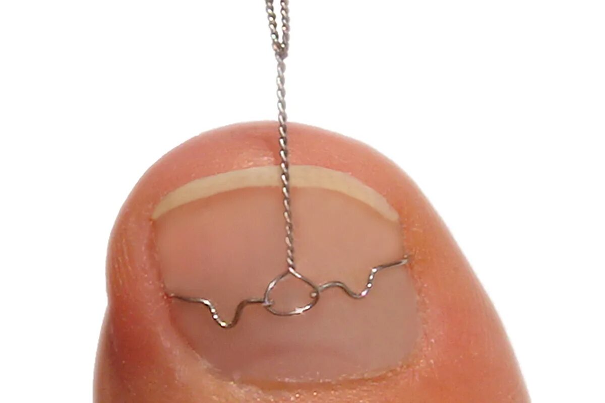 исправление вросшего ногтя пластиной. скоба фрезер подология. ортопедические скобы для ног. скоба фрезер подология. металлическая пластина для вросшего ногтя.