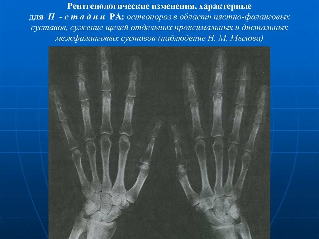 Артрит фаланговых суставов. Ревматоидный артрит пястно-фаланговых суставов. Ревматоидный артрит межфаланговые. Ревматоидный артрит проксимальных межфаланговых. Ревматоидный артрит пястно фаланговый сустав.