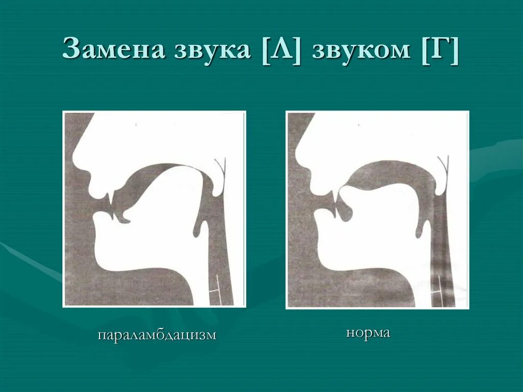 Артикуляция г. Ламбдацизм. Губно-губной ламбдацизм. Артикуляция звука л. Произношение звука л.