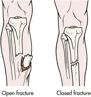 Open fracture