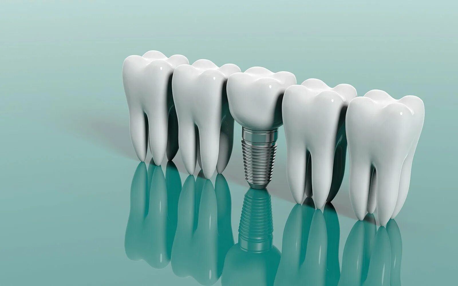 Dental implantation. Dental implantation. Dental implantation. Dental implantation. Dental implantation.