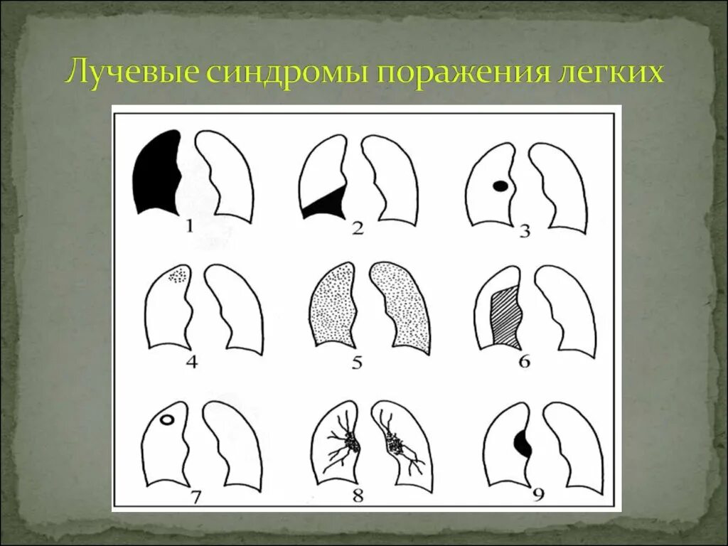 Поражен легких 3. Лучевые симптомы и синдромы поражения легких. Лучевые симптомы поражения легких. Лучевая анатомия легких.