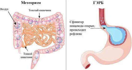 Не выходят газы из кишечника