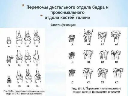 Перелом скуловой кости тесты нмо