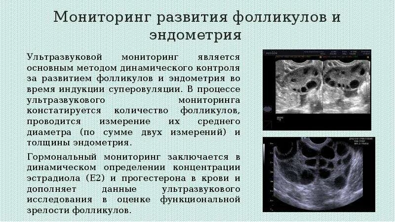 Синдром гиперстимуляции яичников УЗИ. Гиперстимуляция яичников после пункции. УЗИ мониторинг фолликулов. Яичники при гиперстимуляции. Фолликула стимулирующий