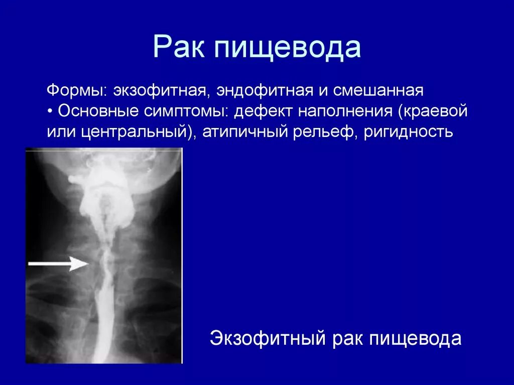 С г пищевода