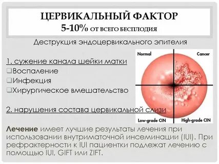 Цервикальный канал 35
