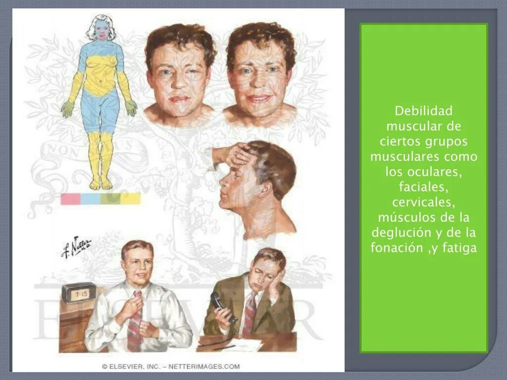 Синдром ламберта итона. Миастеническим синдромом ламберта—итона. миастения ламберта итона. генерализованная миастения. для миастенического синдрома ламберта-итона характерен.
