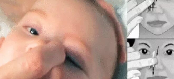 Как делают зондирование слезного. Дакриоцистит массаж слезного канала у новорожденных. дакриоцистит массаж слезного канала. массаж глаз у грудничка при дакриоцистите новорожденных. дакриоцистит комаровский.
