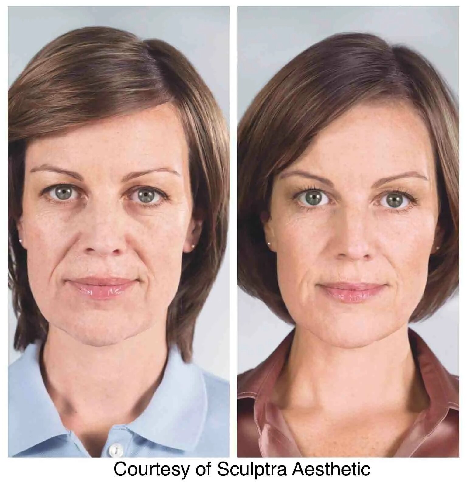 Sculptra филлер. Скульптра sculptra. Скульптра sculptra до и после. Препарат скульптра косметология. Sculptra фото.