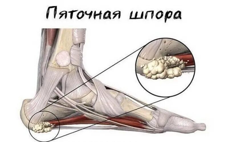 Как называется пяточная шпора. Пяточная шпора симптомы.