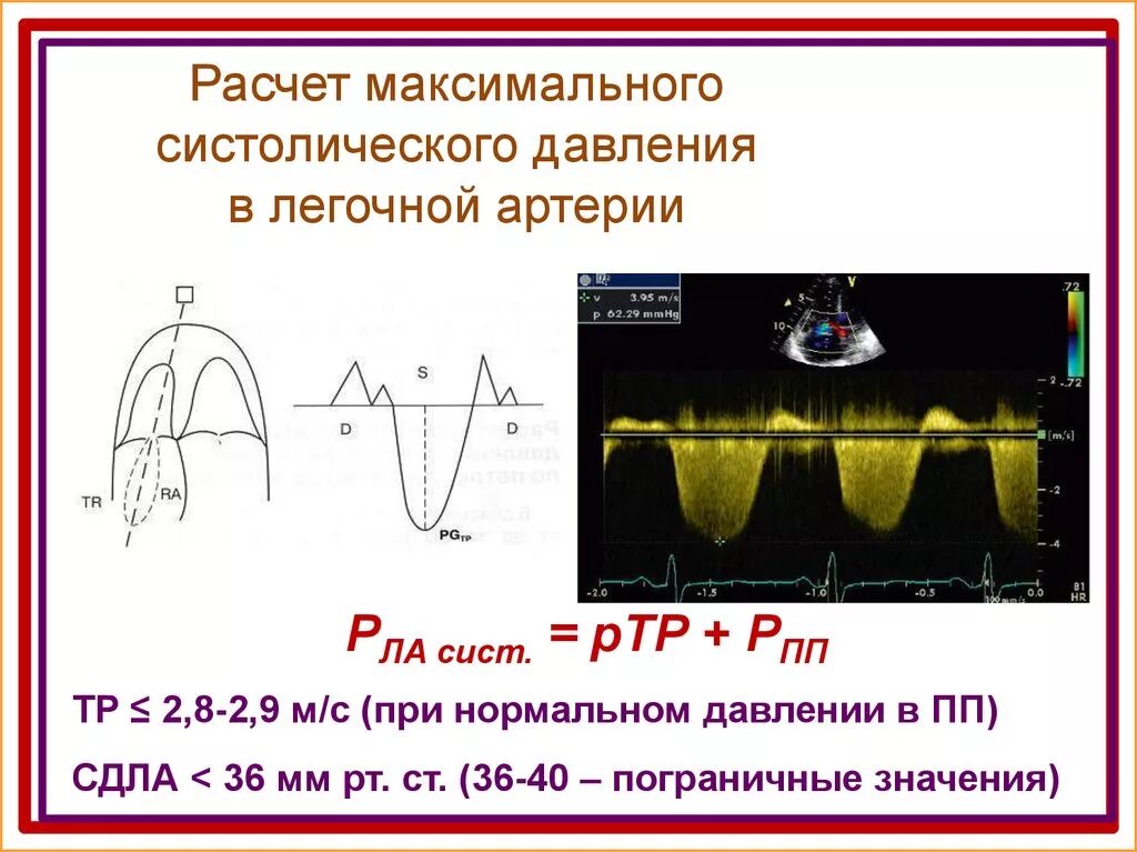 Измерение давления в легочной артерии при ЭХОКГ. Измерение систолического давления в легочной артерии на ЭХОКГ. Расчет давления в легочной артерии. Расчет систолического давления в легочной артерии. Легочная гипертензия сдла